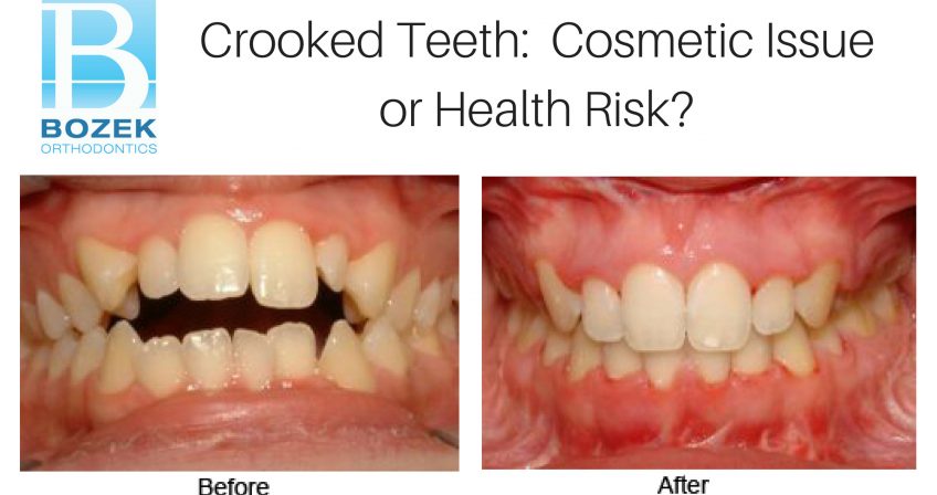 Crooked Teeth: Cosmetic Issue or Health Risk?