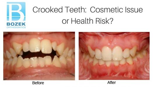 Crooked Teeth: Cosmetic Issue or Health Risk?