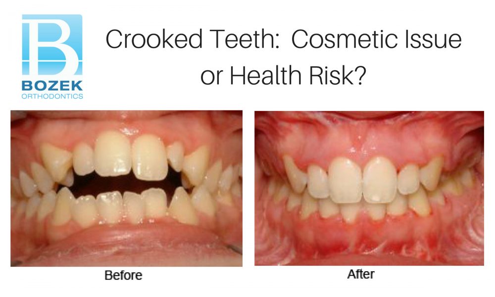 Crooked Teeth: Cosmetic Issue or Health Risk?
